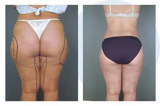 liposuction$41 Patient 41