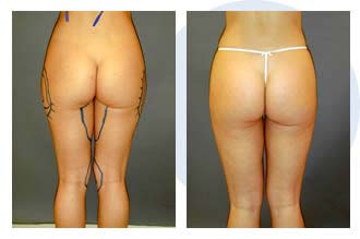 liposuction$42 Patient 42