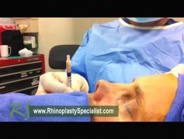Nose Surgery Beverly Hills | Dr. Paul Nassif