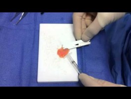 Rhinoplasty Surgical Technique: Placing Cartilage in Syringe