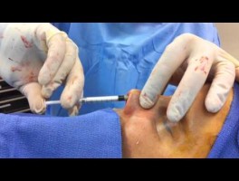Rhinoplasty Surgical Techniques: Injecting cartilage