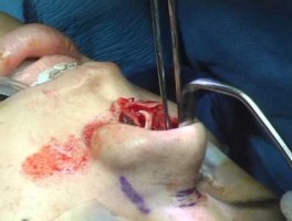 Rhinoplasty Surgical Technique w/ Dr. Paul Nassif: Osteotomies & Nasal Dorsum Buildup