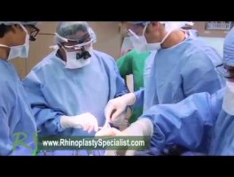 Rhinoplasty Surgical Technique w/ Dr. Paul Nassif : DCF.