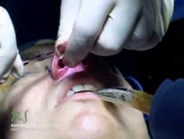 Closing Incisions After Rhinoplasty w/ Dr. Nassif