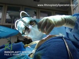 OR Video Footage: Closing the Incisions After Rhinoplasty