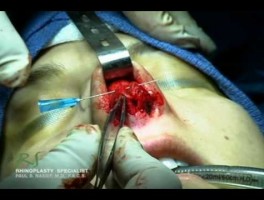 OR Video Footage: Inside a Rhinoplasty Surgery