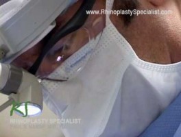 How Nose Surgery is Performed