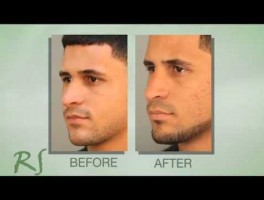 Rhinoplasty Patient Before and After Video