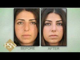 Rhinoplasty on Beverly Hills Female, Amazing Results!