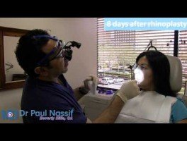 Maria’s Patient Experience – Rhinoplasty 8 Days Post-op Follow Up Consultation