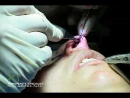 Dr. Nassif’s Closed Rhinoplasty How To – Columellar Strut