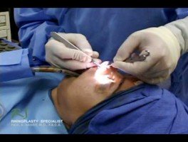 Dr. Nassif’s Closed Rhinoplasty How To – Exposing Nasal Skeleton