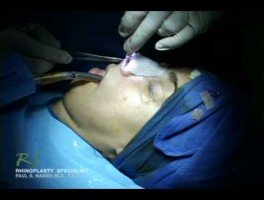 Dr. Nassif’s Closed Rhinoplasty How To – Closing Incision