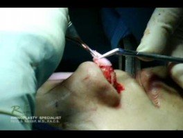 OR Video Footage: Live Revision Rhinoplasty
