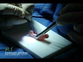 OR Video Footage: Carving Rib Cartilage for Rhinoplasty