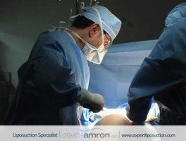 Hips Liposuction Surgery by Hip Lipo Surgeon Dr. David Amron