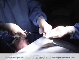 Neck Liposuction Surgery by Los Angeles Surgeon Dr. David Amron