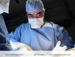 Outer Thighs Hip Liposuction by Beverly Hills Lipo Surgeon Dr. David Amron