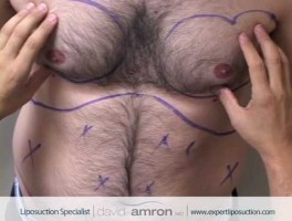 Male Chest Liposuction Gynecomastia Lipo Surgery by Beverly Hills Cosmetic Surgeon