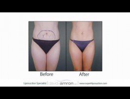 Liposuction Techniques SmartLipo Lipo Dissolve MesoTherapy by LA Lipo Surgeon Dr. David Amron