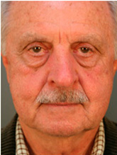 Before patient Photo