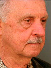 Before patient Photo 2