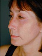 After patient Photo 2