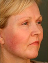 After patient Photo 2