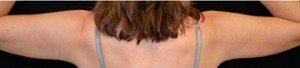 After patient Photo