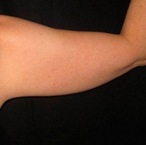 After patient Photo 2