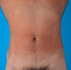 After patient Photo