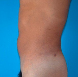 After patient Photo 2